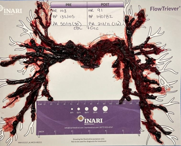 i-raise-you-this-pe-pulled-from-patient-complaining-of-v0-ogniwtp8rgpa1.jpg