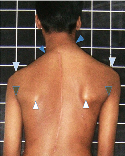 Post-operative-shoulder-imbalance-demonstrating-the-marking-of-the-neck-inflexion-points.png