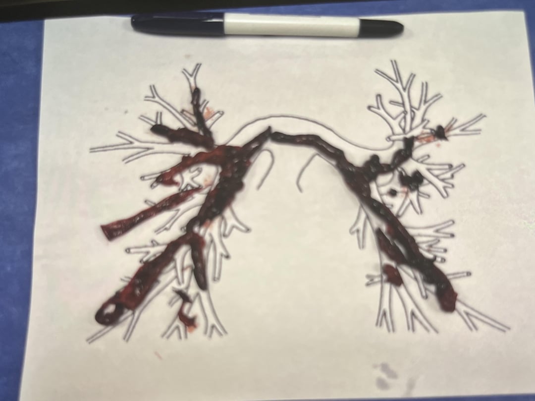 the-saddle-pe-our-cath-lab-just-pulled-outta-somebody-v0-lera7s3oueac1.jpeg